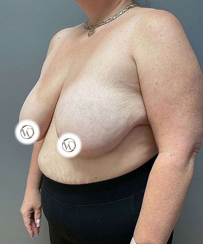 Breast Lift Before & After