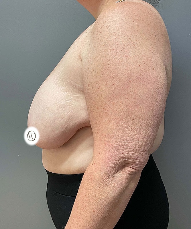 Breast Lift Before & After