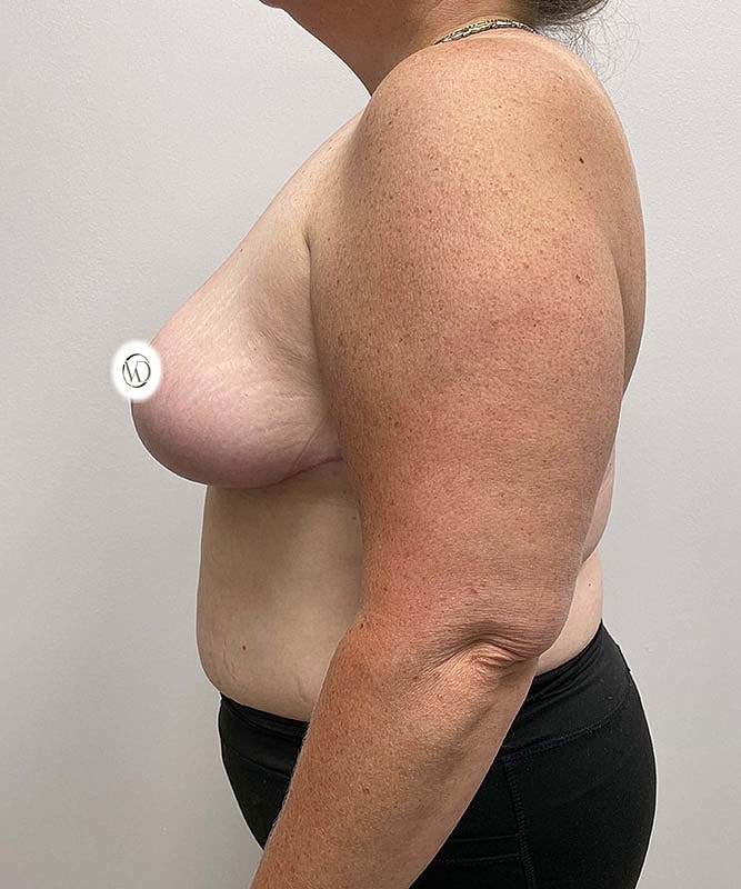 Breast Lift Before & After