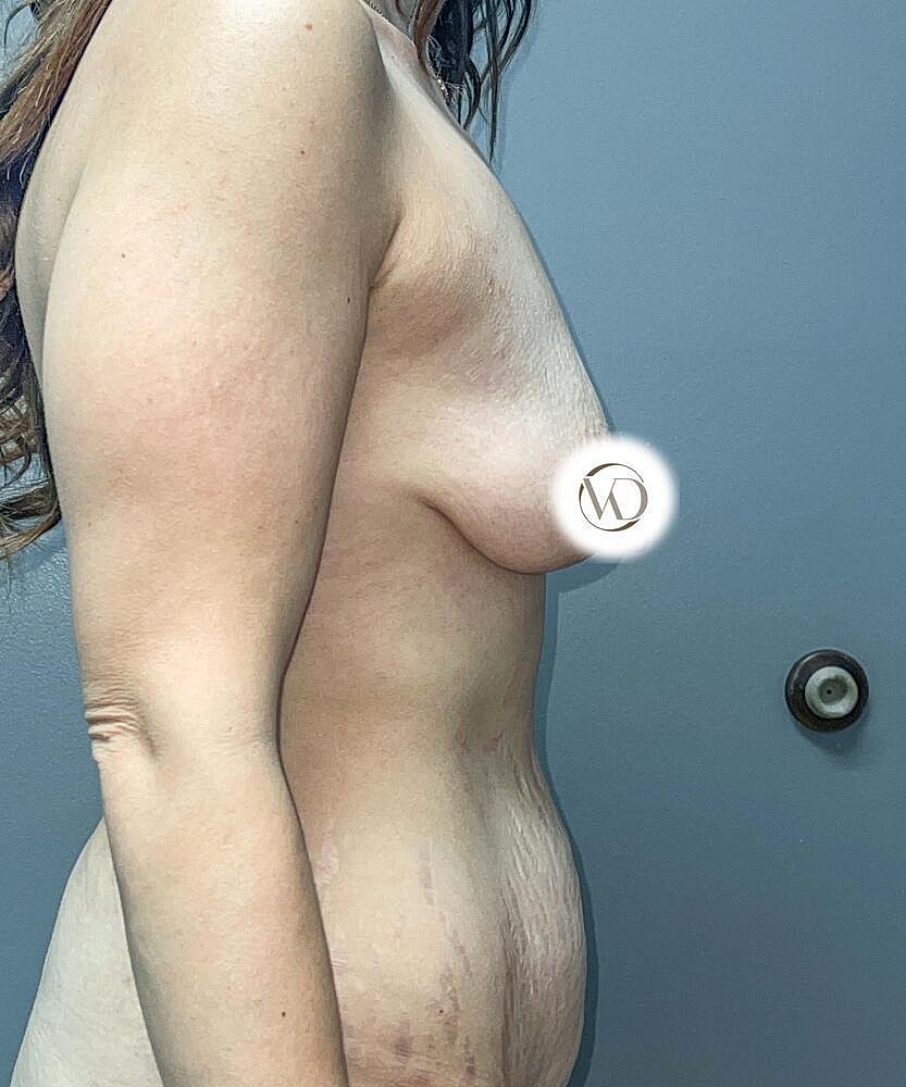 Breast Lift Before & After