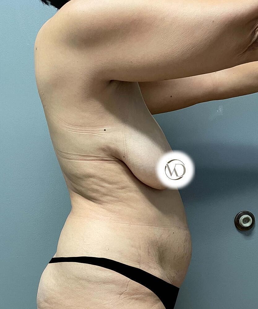 Breast Lift Before & After