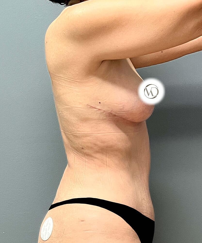 Breast Lift Before & After