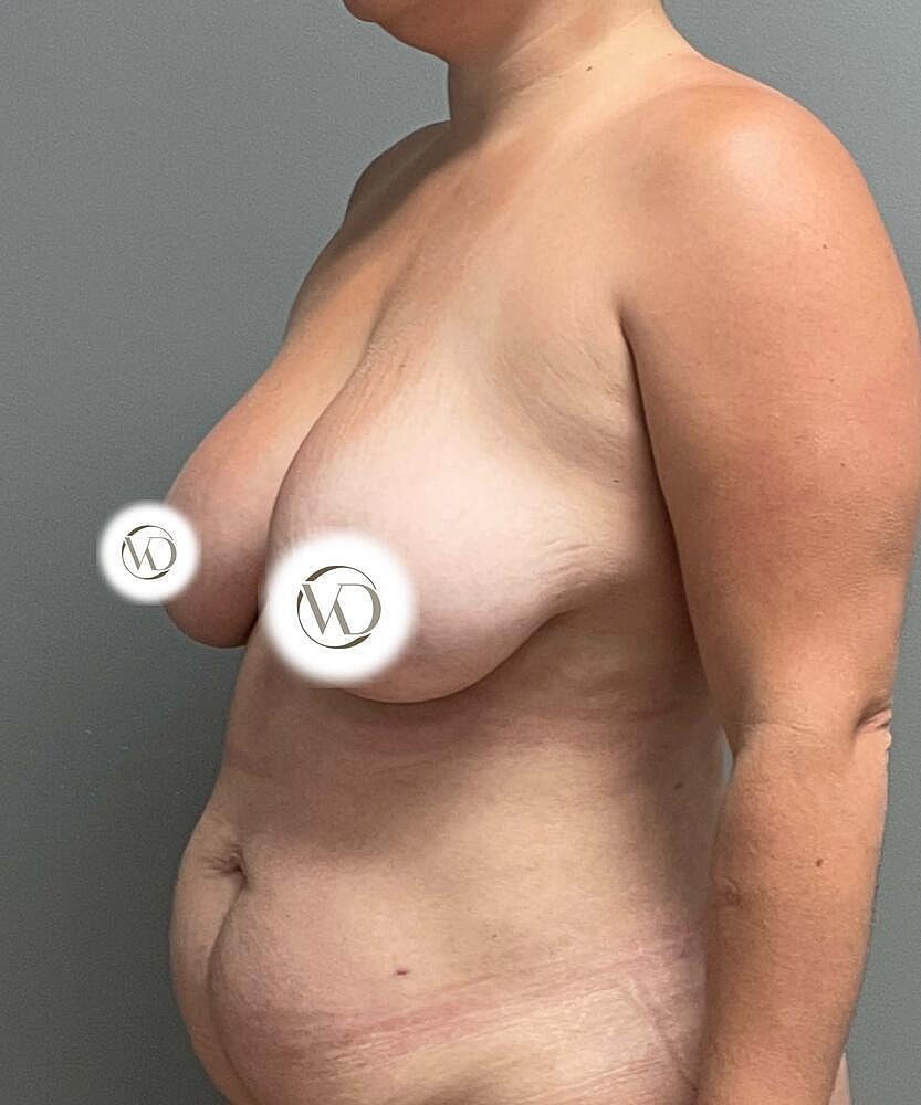 Breast Lift Before & After