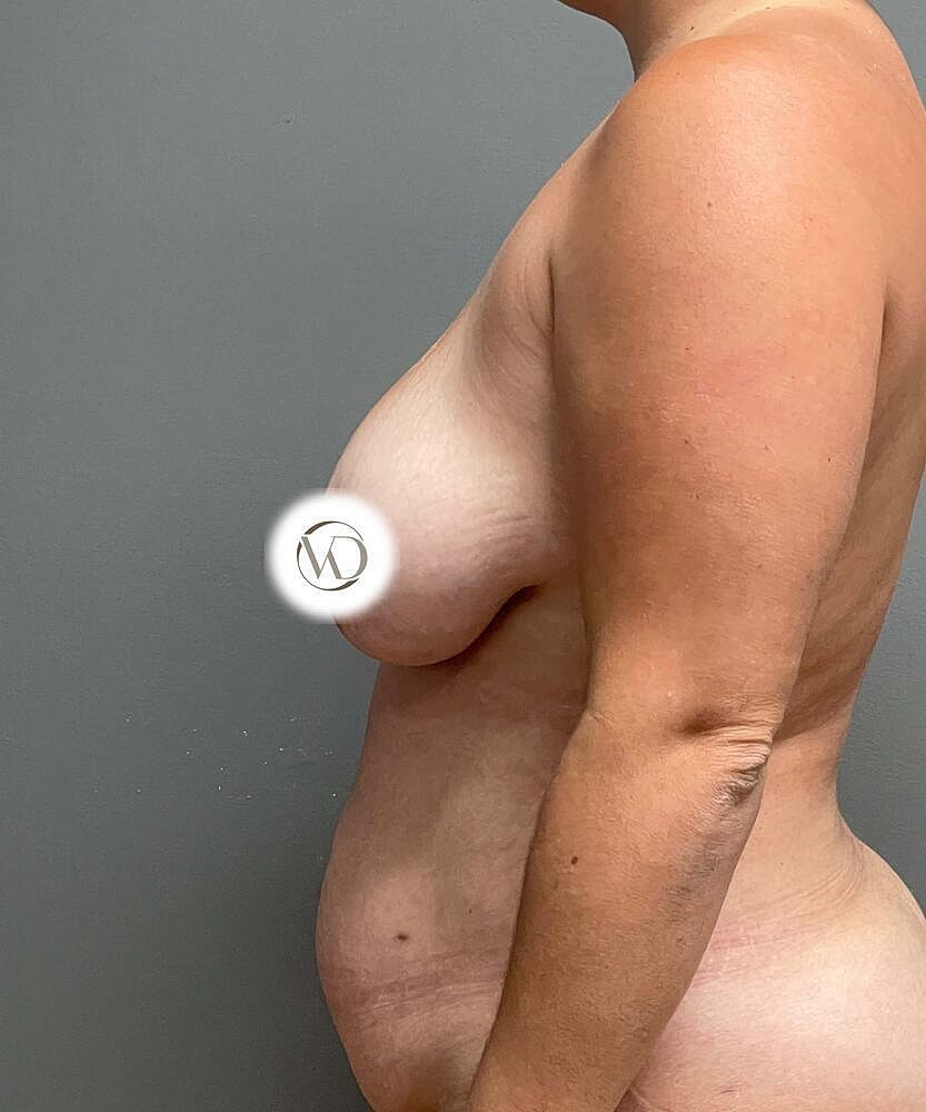 Breast Lift Before & After