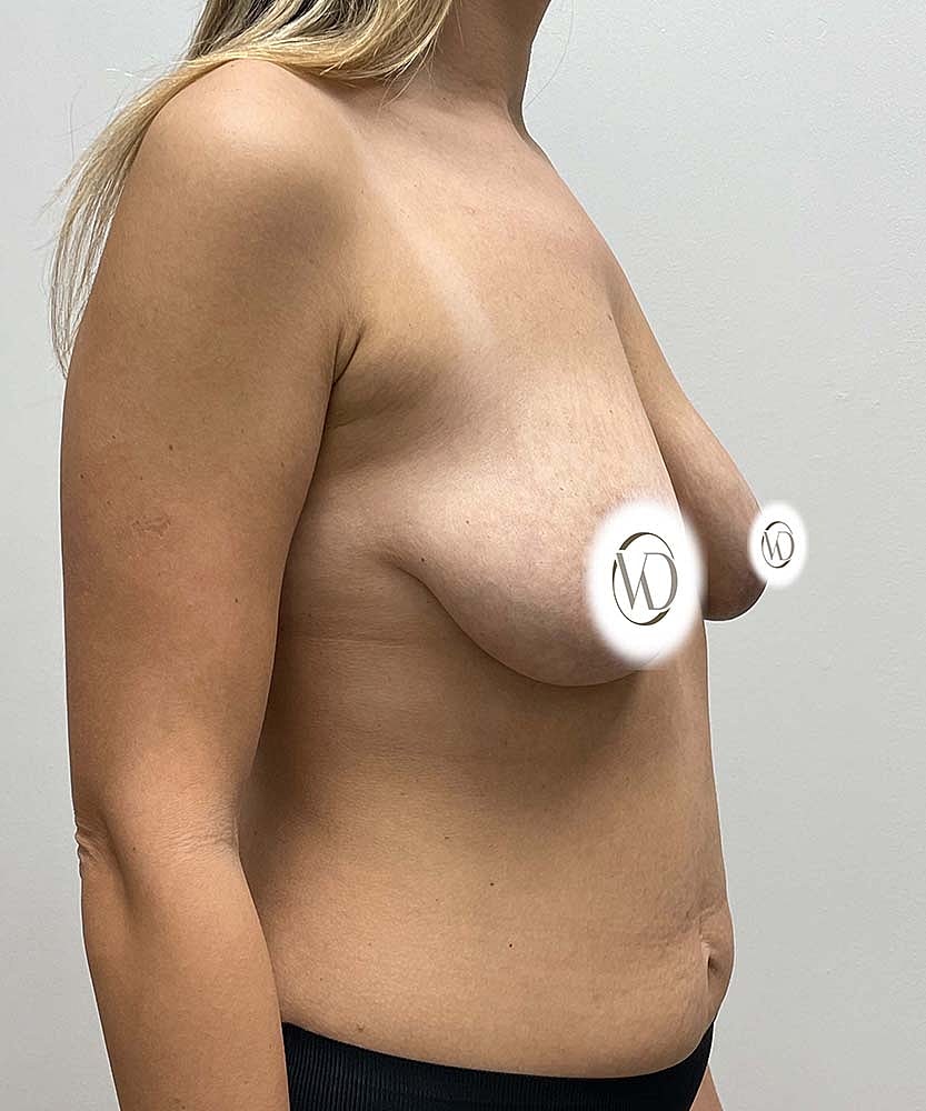 Breast Lift Before & After