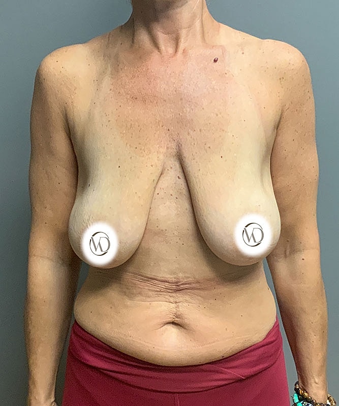 Breast Lift Before & After