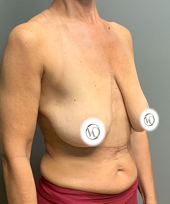 Breast Lift Before & After
