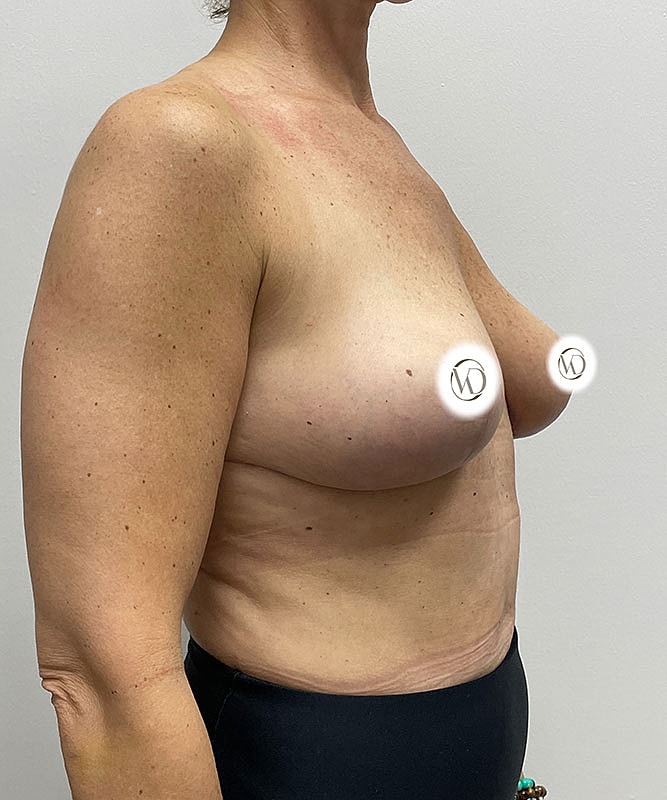 Breast Lift Before & After