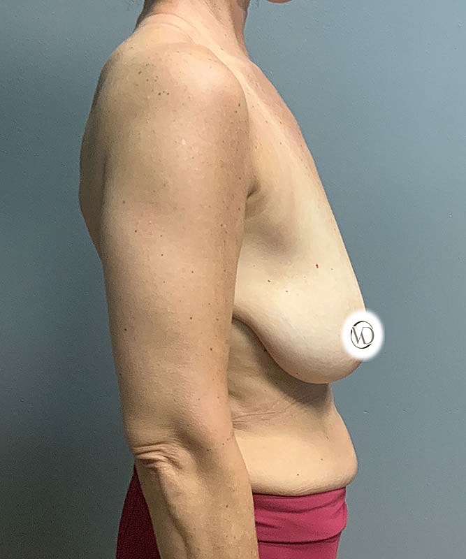Breast Lift Before & After