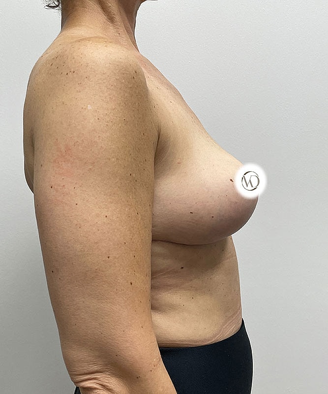 Breast Lift Before & After