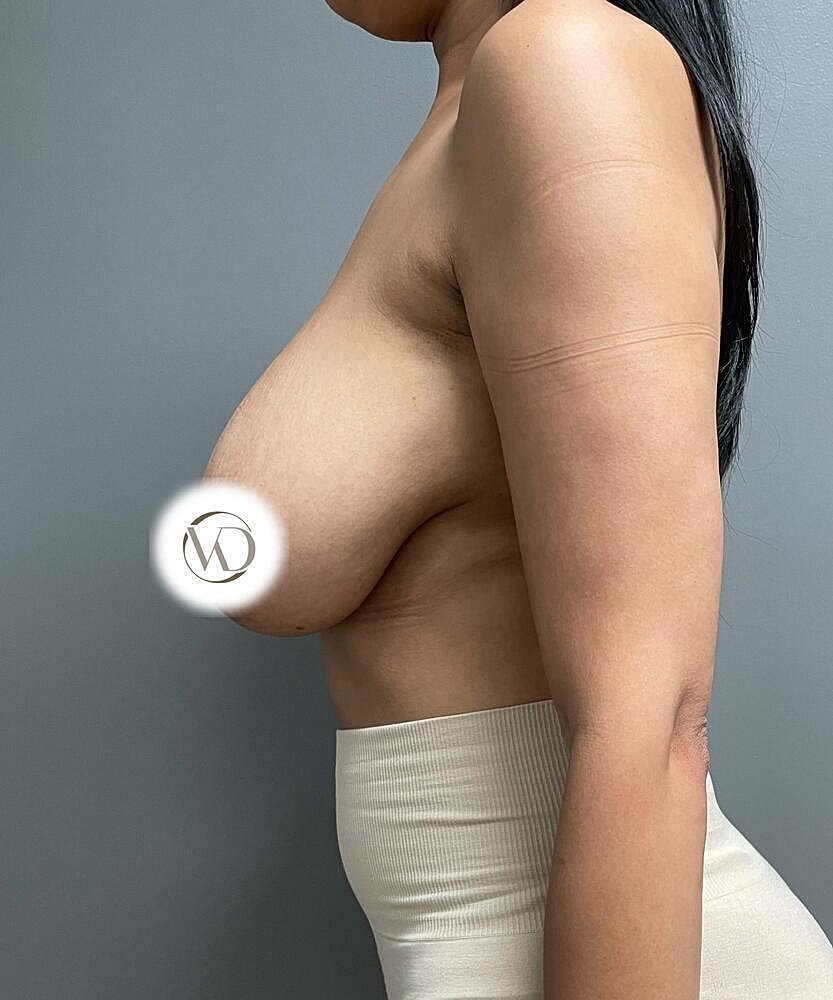 Breast Lift Before & After