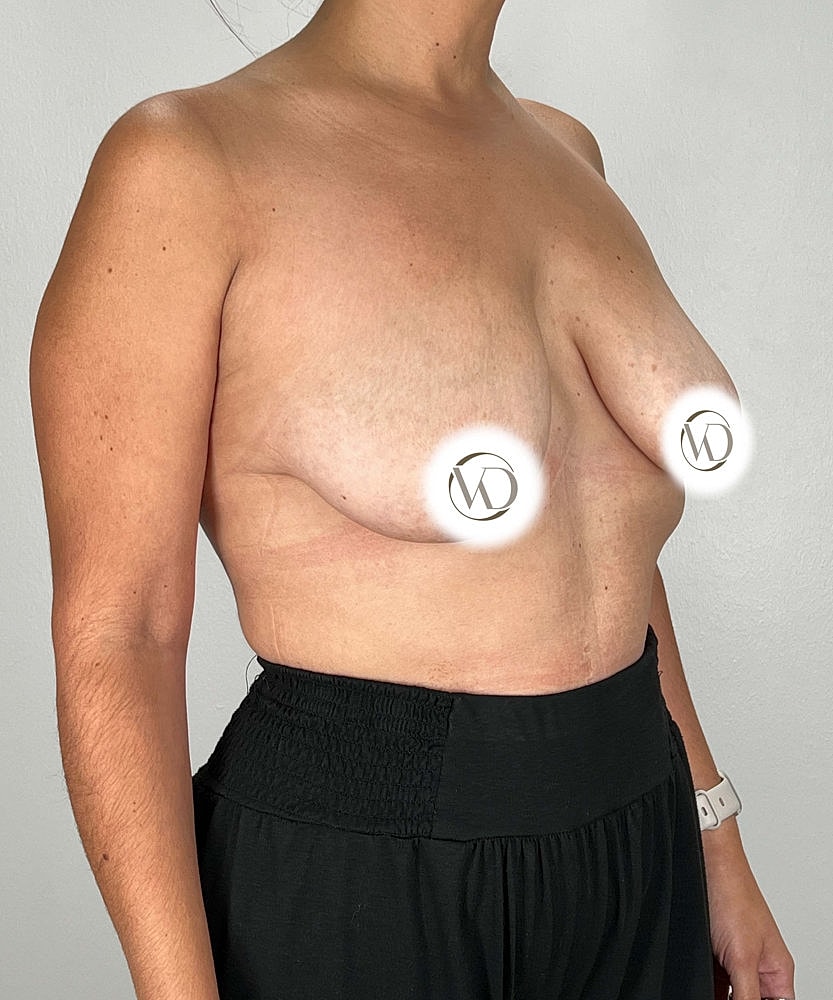 Breast Lift Before & After