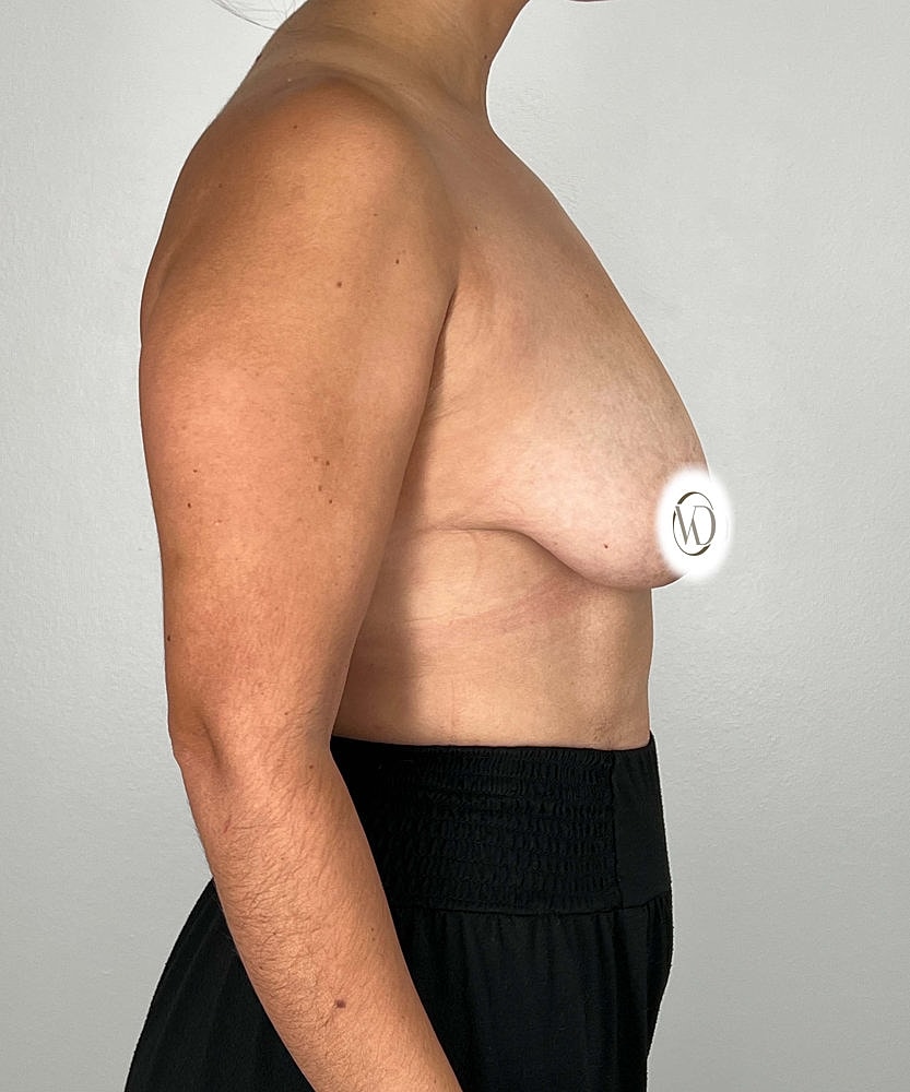 Breast Lift Before & After