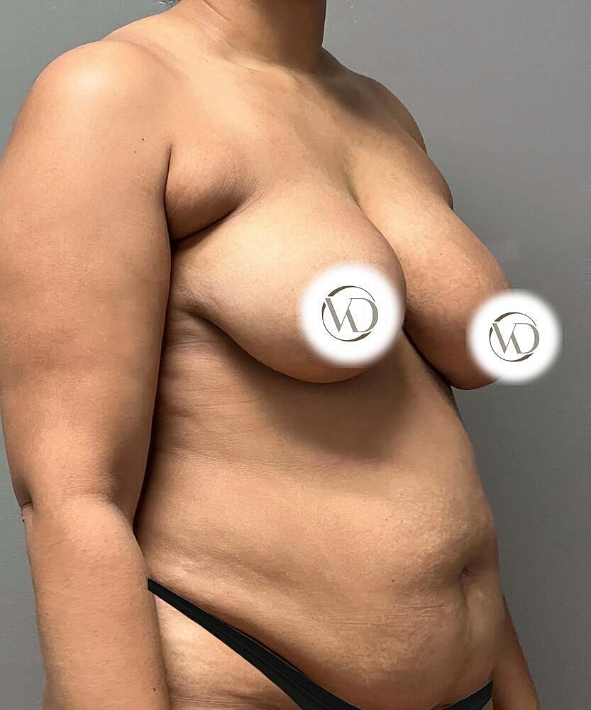 Breast Lift Before & After