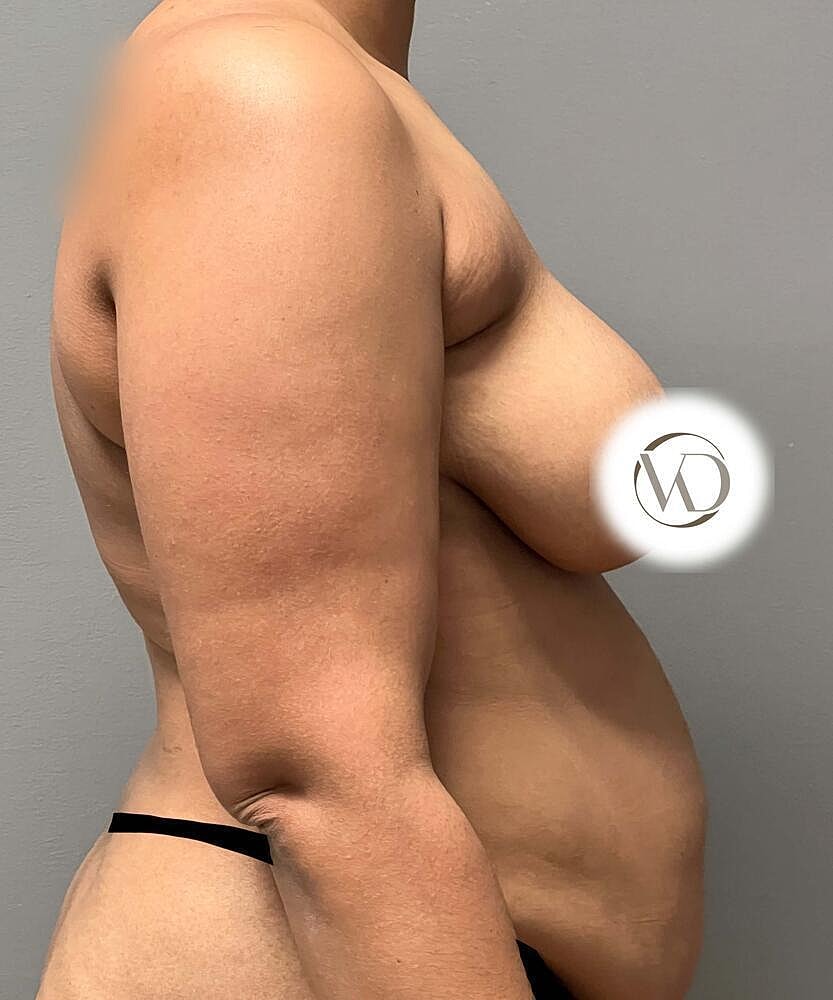 Breast Lift Before & After