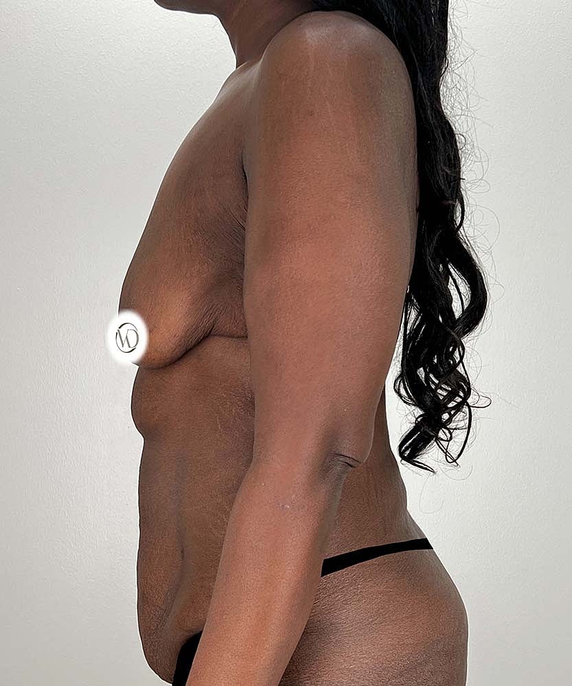 Breast Lift Before & After