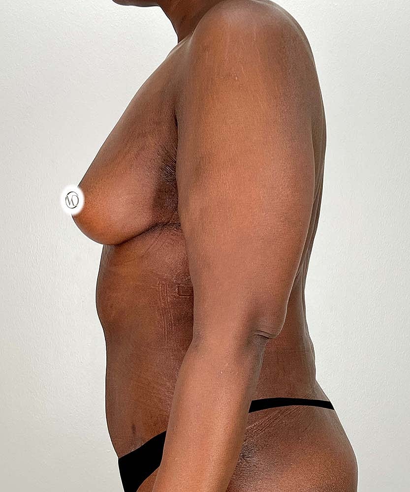 Breast Lift Before & After