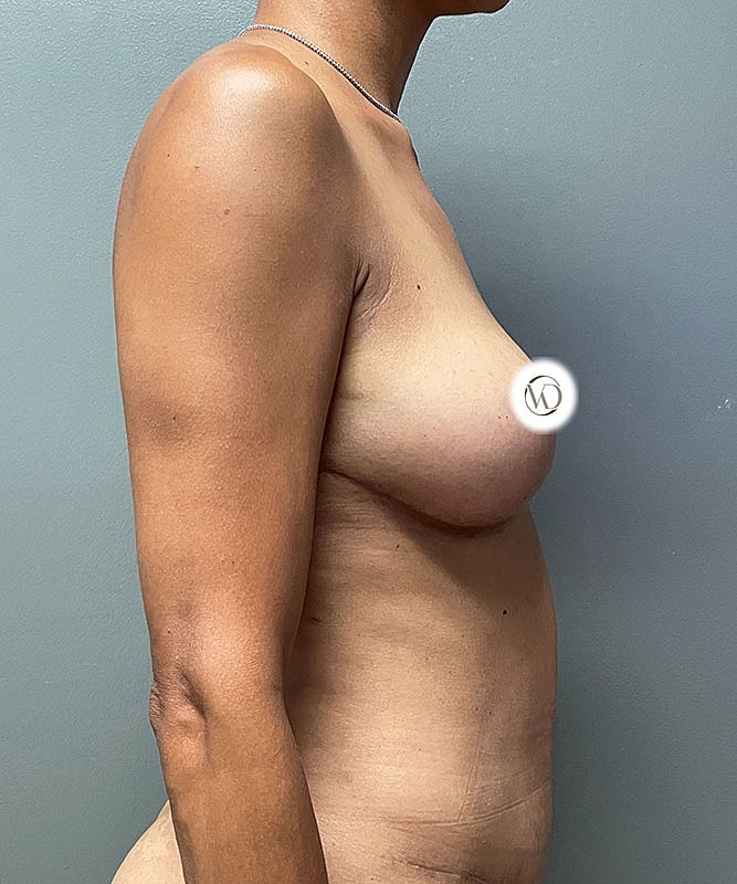 Breast Lift Before & After