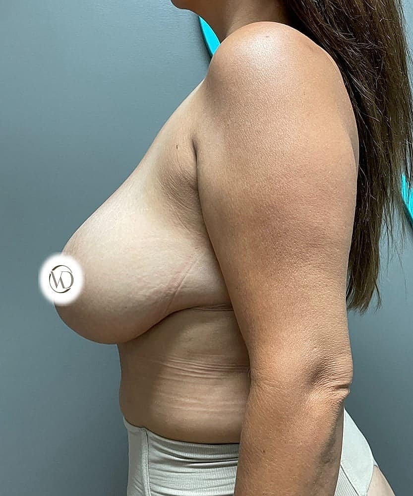 Breast Lift Before & After