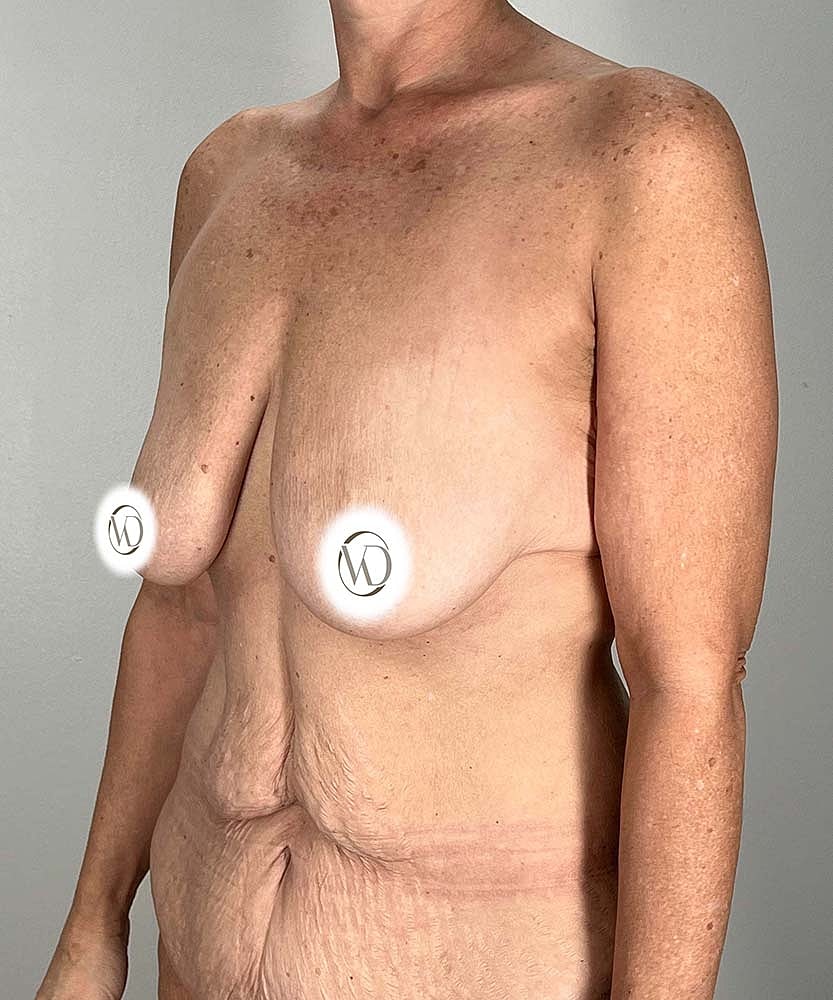 Breast Lift Before & After