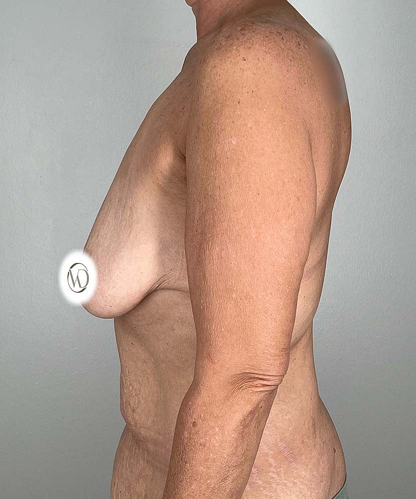 Breast Lift Before & After