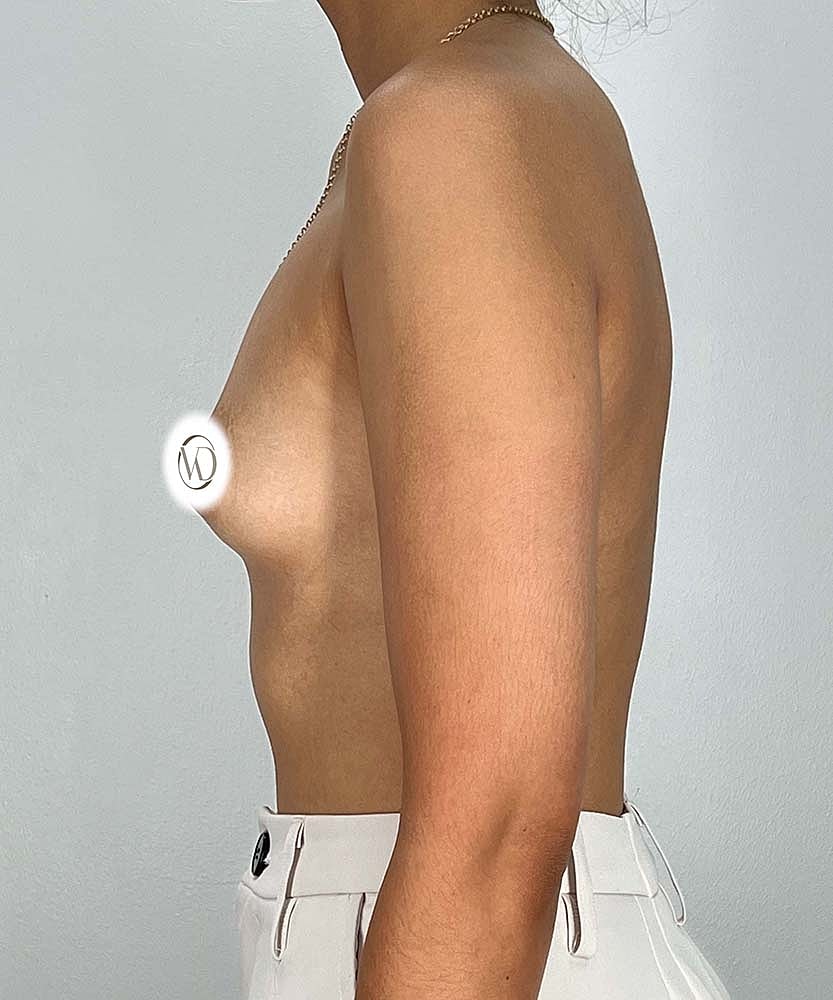 Breast Augmentation Before & After