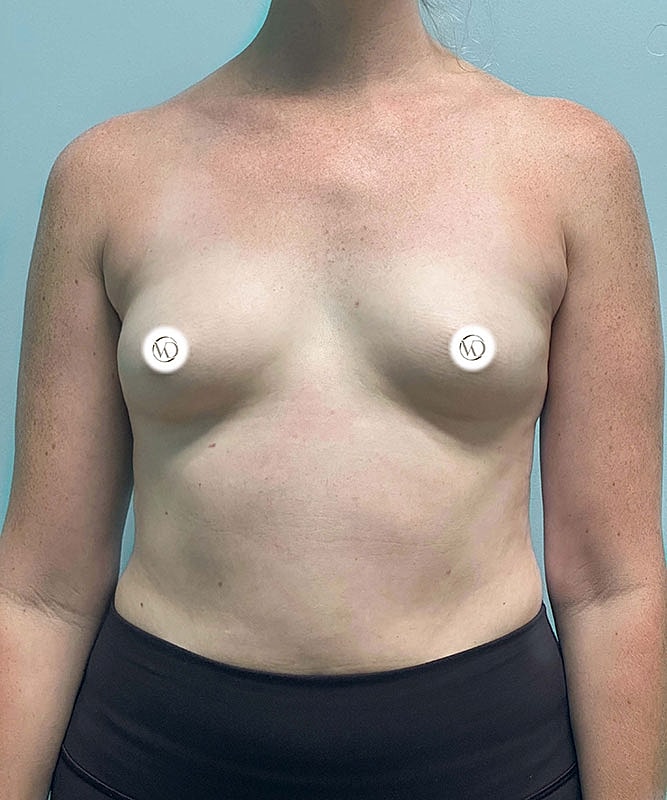 Breast Augmentation Before & After