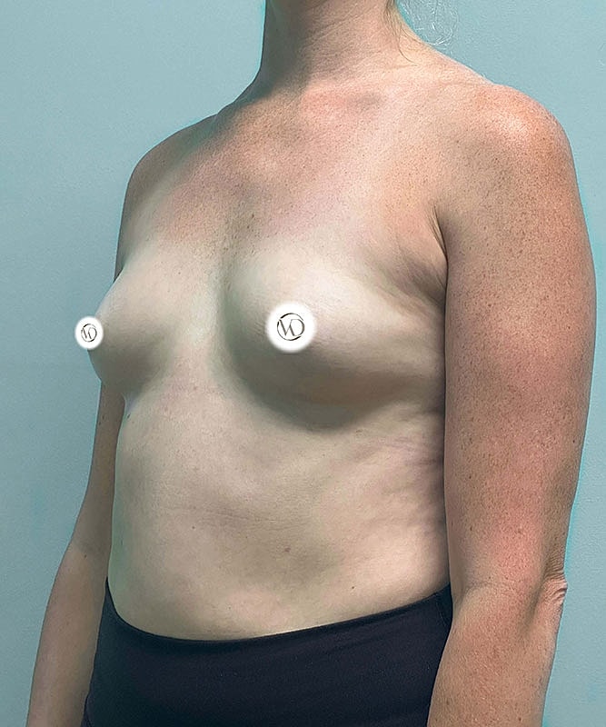 Breast Augmentation Before & After