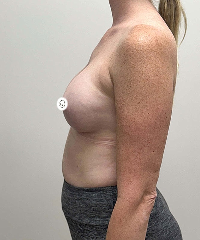 Breast Augmentation Before & After