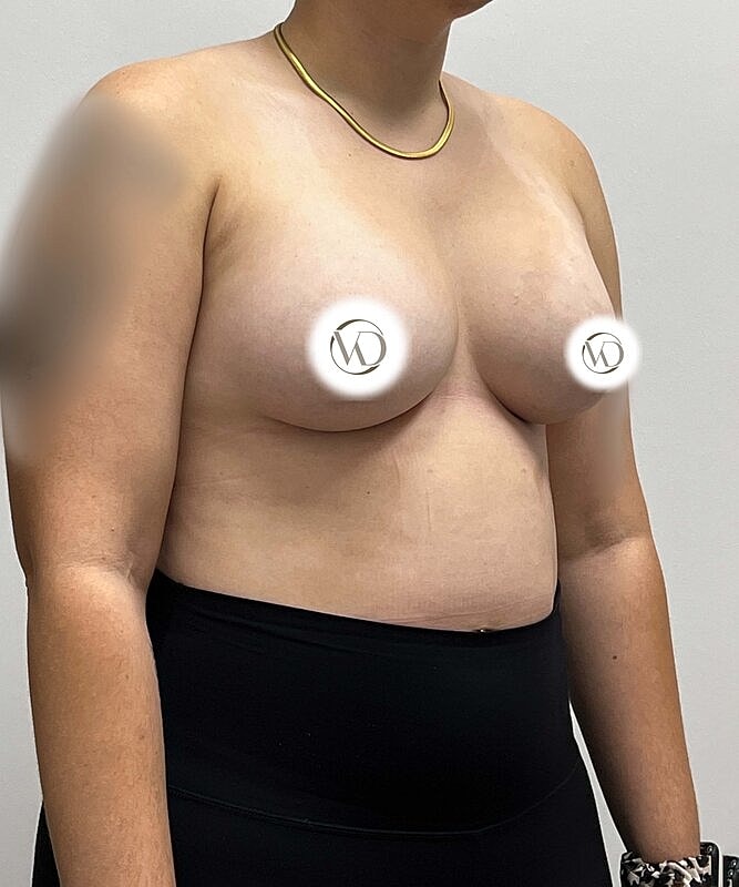 Breast Augmentation Before & After