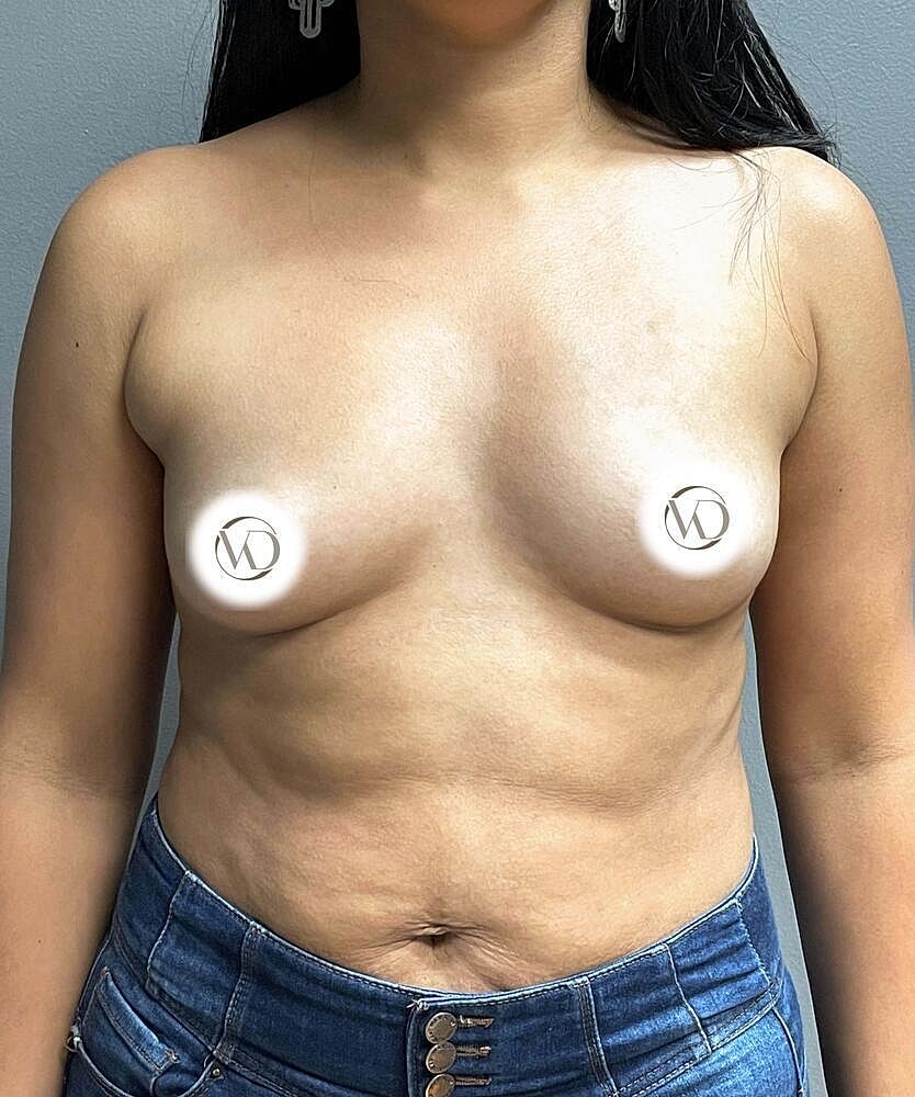 Breast Augmentation Before & After