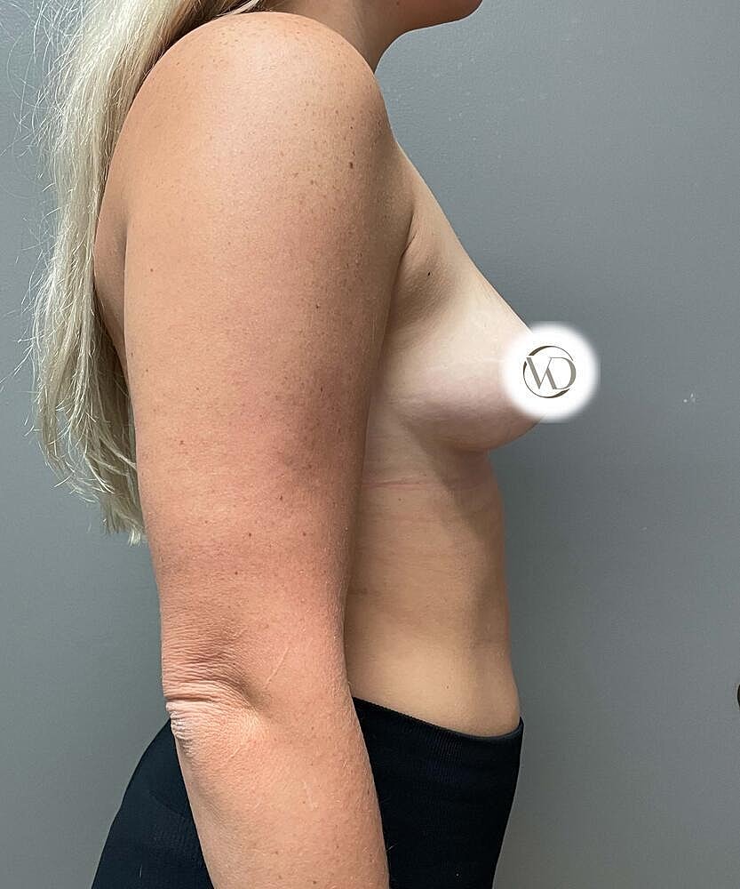 Breast Augmentation Before & After
