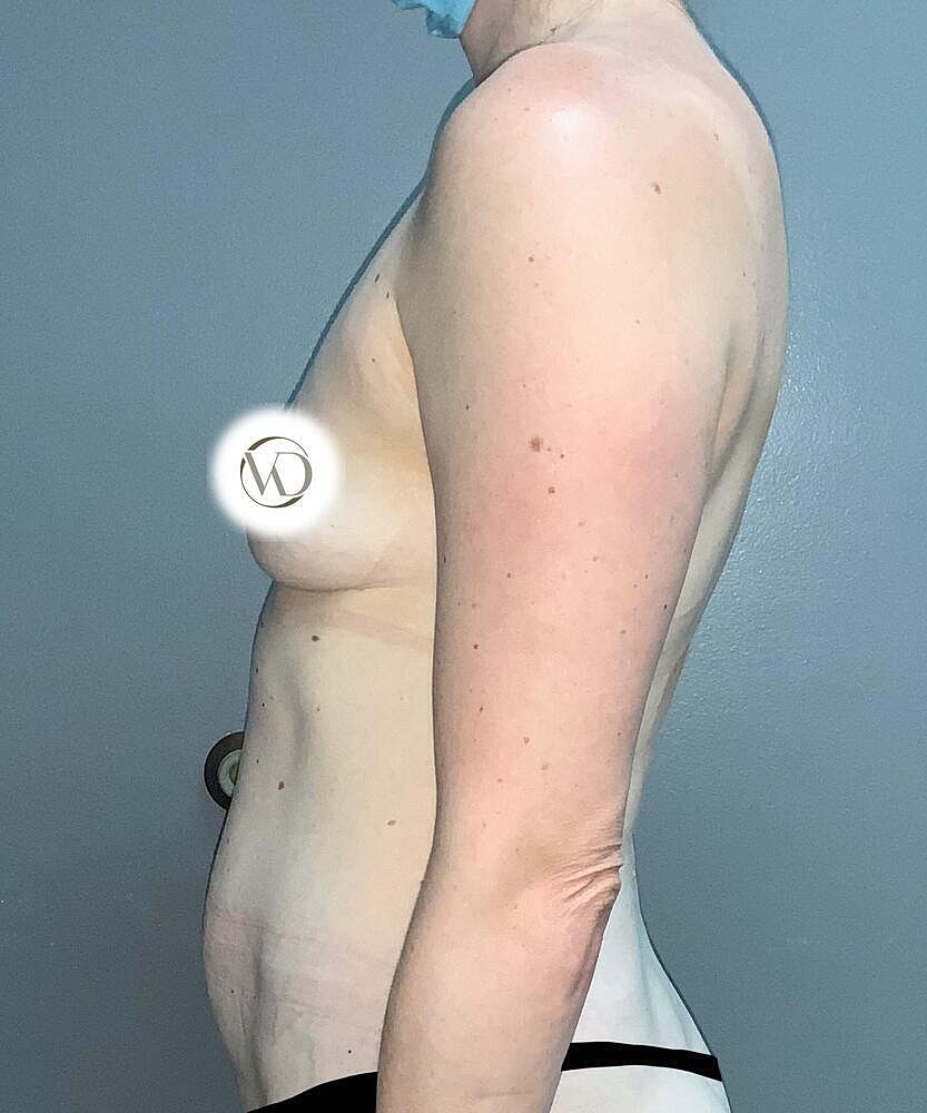 Breast Augmentation Before & After