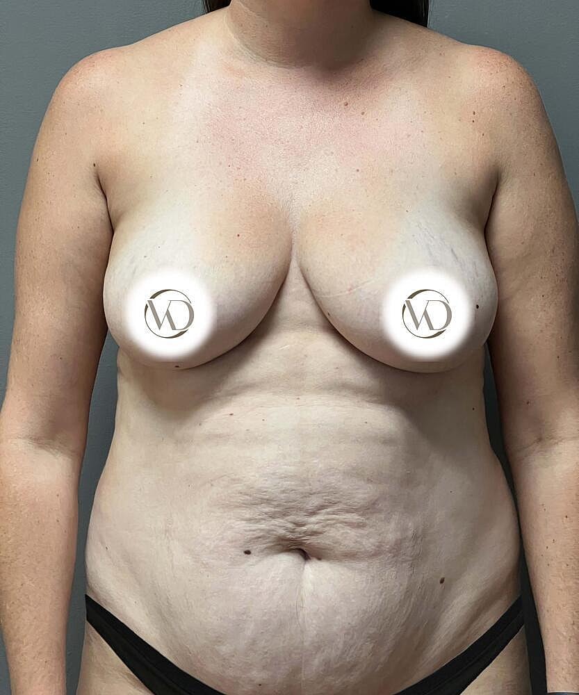 Breast Augmentation Before & After