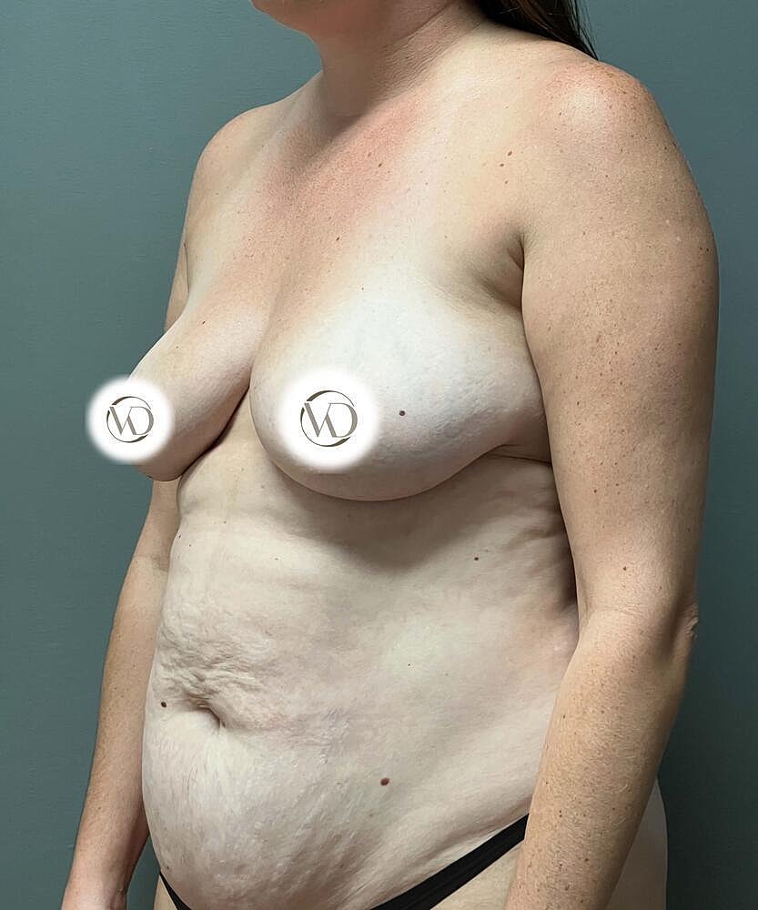 Breast Augmentation Before & After