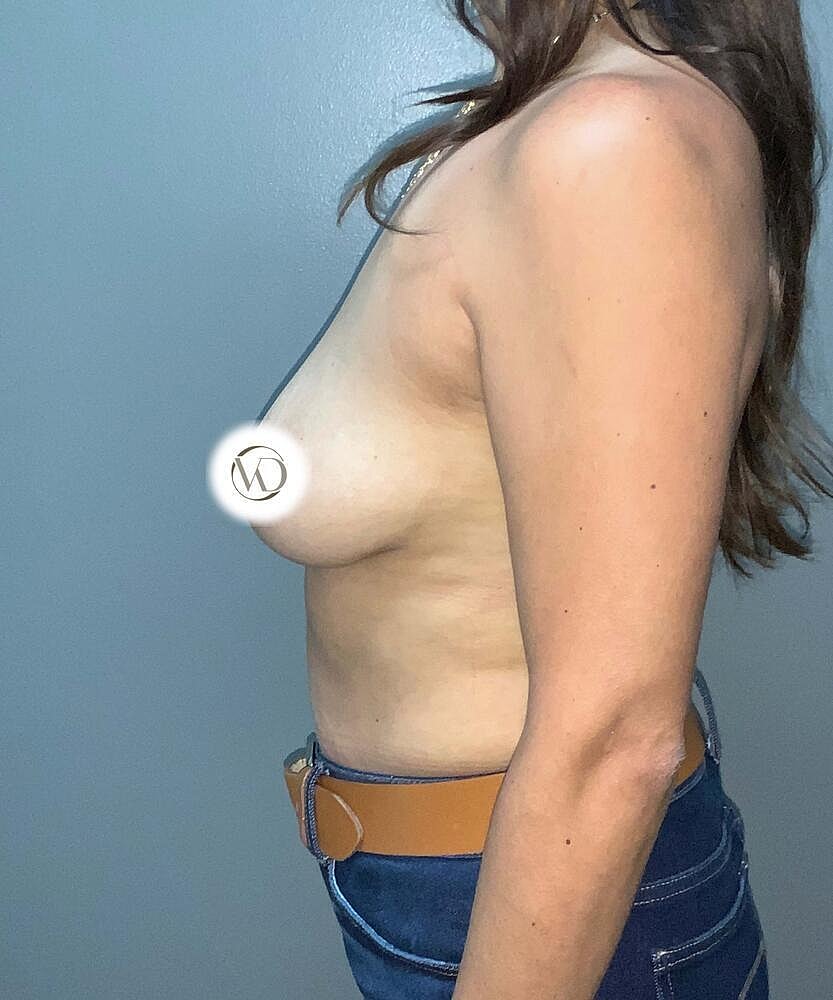 Breast Augmentation Before & After
