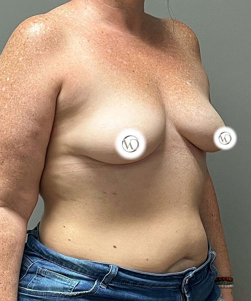Breast Augmentation Before & After