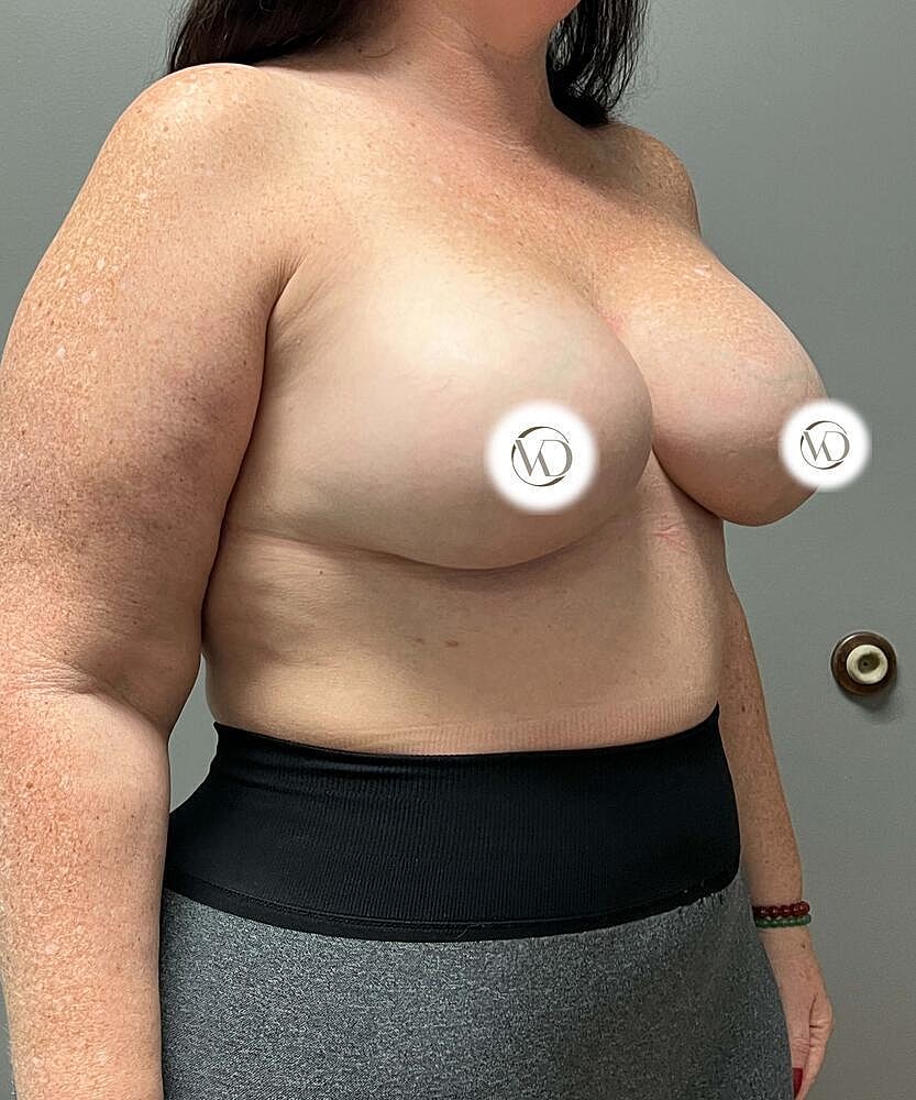 Breast Augmentation Before & After