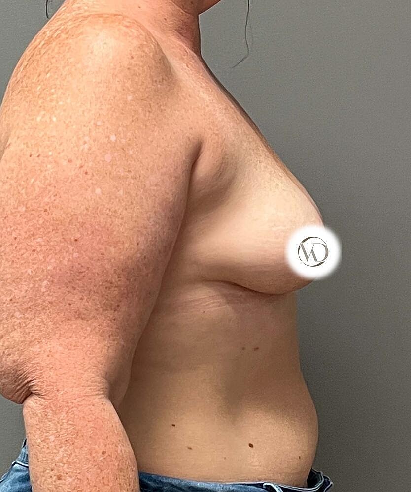 Breast Augmentation Before & After