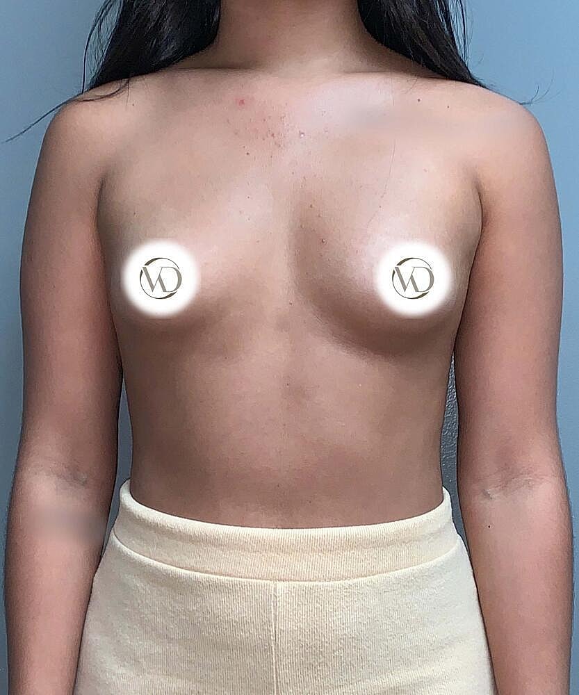 Breast Augmentation Before & After