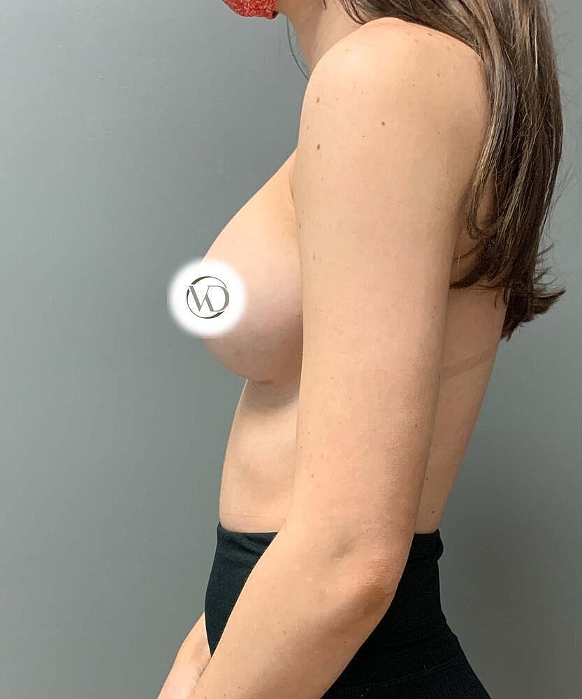 Breast Augmentation Before & After
