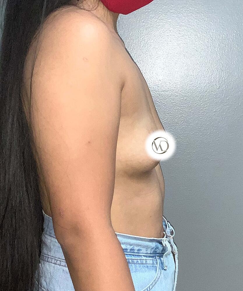 Breast Augmentation Before & After