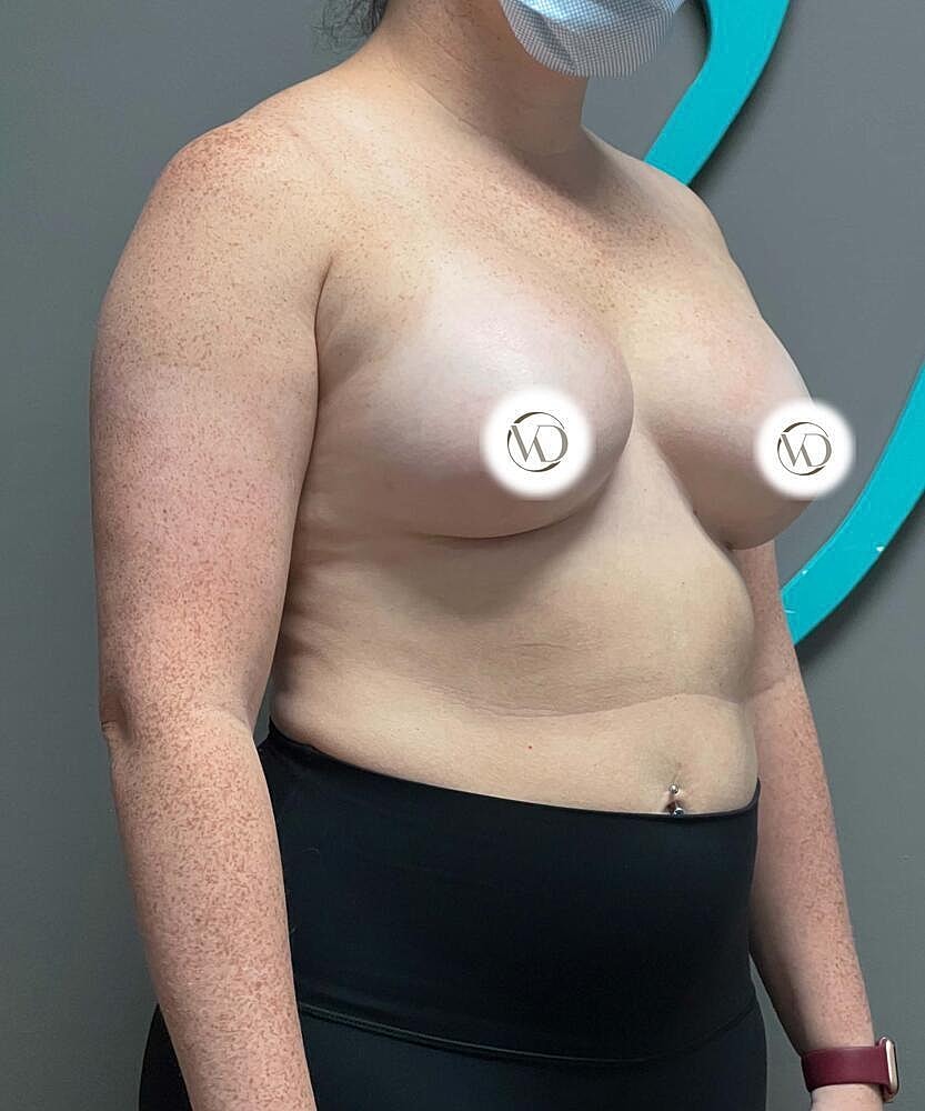 Breast Augmentation Before & After