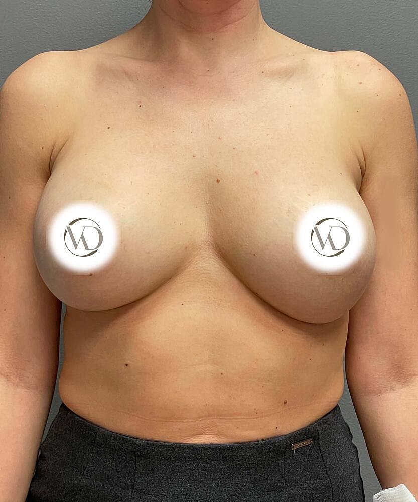 Breast Augmentation Before & After