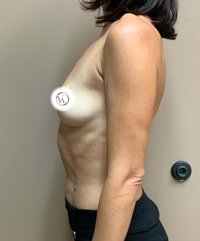 Breast Augmentation Before & After