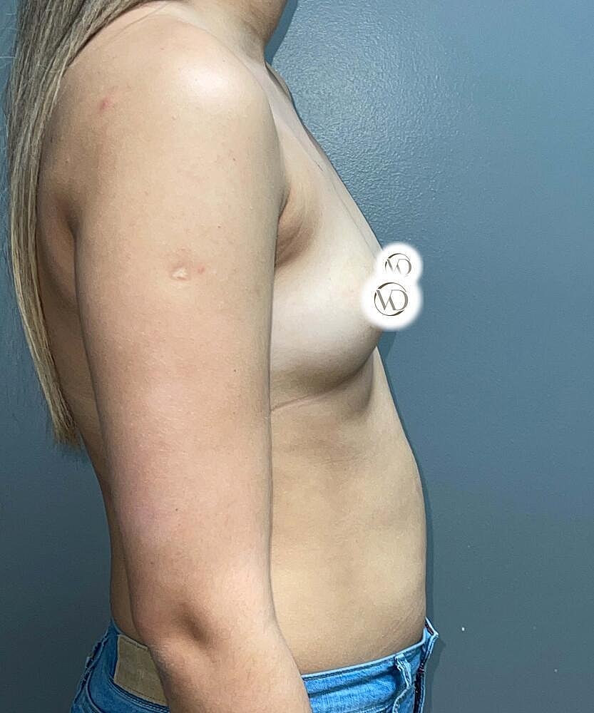 Breast Augmentation Before & After