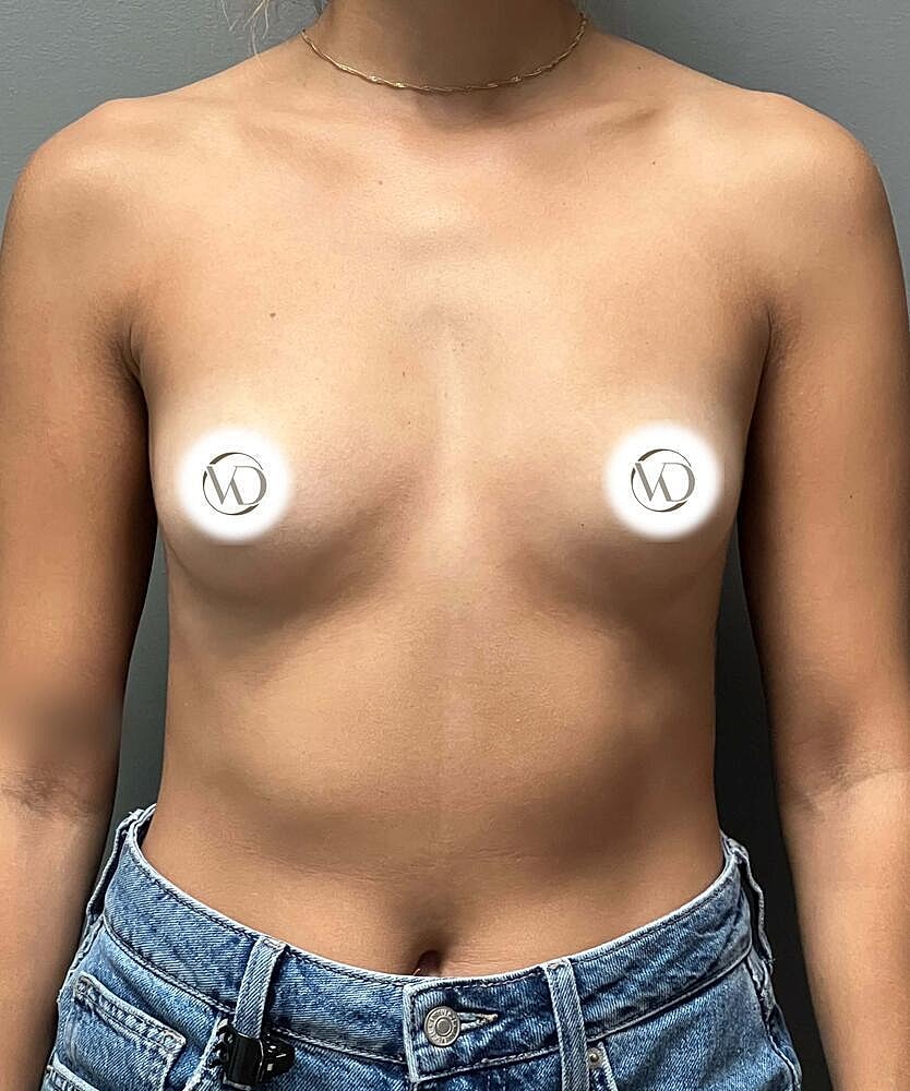 Breast Augmentation Before & After