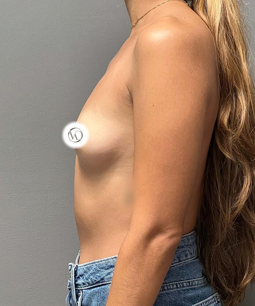 Breast Augmentation Before & After