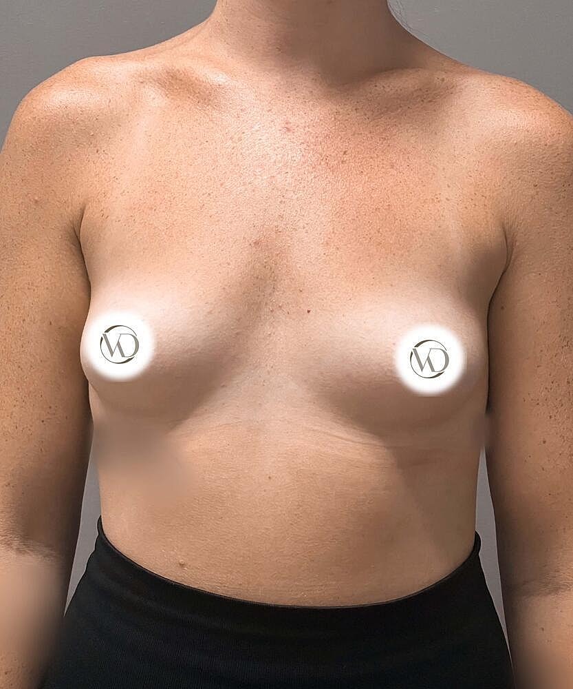 Breast Augmentation Before & After