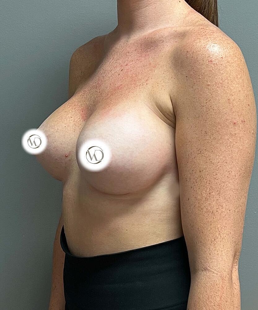 Breast Augmentation Before & After